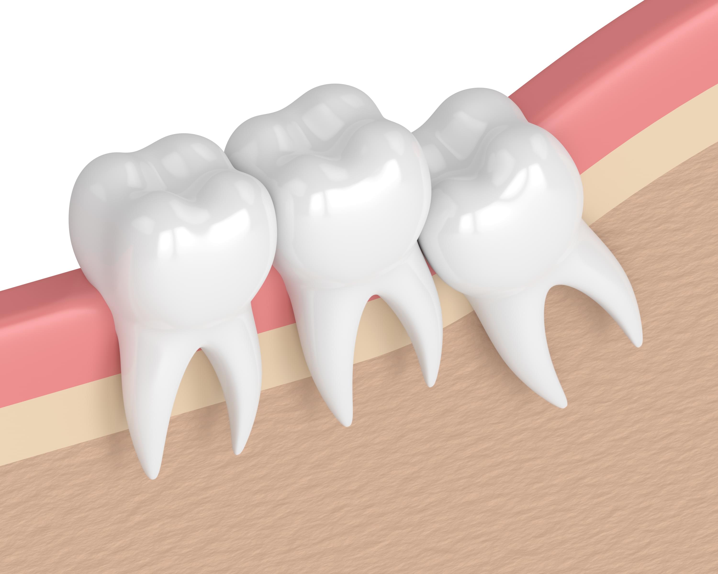 3d render of teeth with wisdom crowding