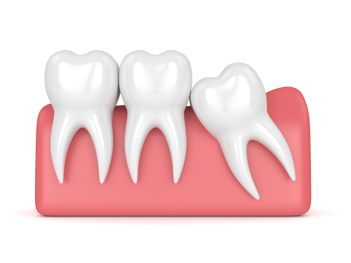 Wisdom Teeth Removal Factors & Recovery Tips