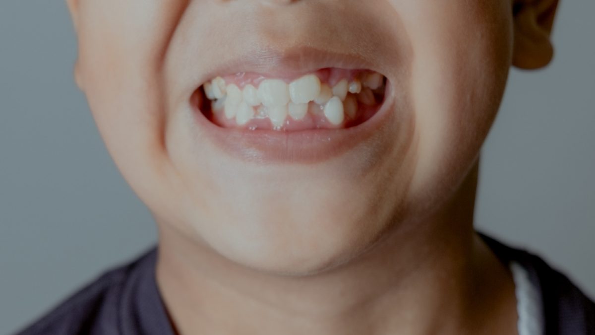 What Happens If You Don't Remove Impacted Wisdom Teeth?