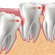 wisdom teeth removal near me-wisdom teeth professionals-sydney