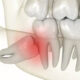 Wisdom Teeth Impactions Signs, Causes, and Risks - wisdom teeth professionals - sydney