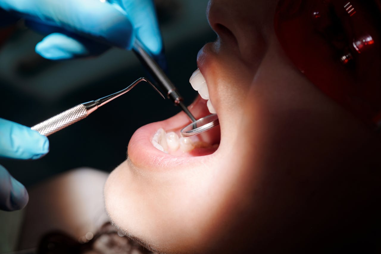 Close-up of open mouth during dental checkup for wisdom teeth removal in Sydney